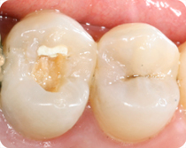 dente devitalizzato