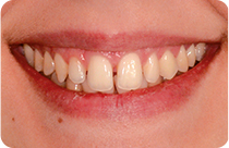 il sorriso di alessia con diastemi, spazi tra i denti, prima dell'intervento