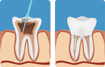 devitalizzazione del dente