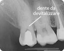 radiografia dente da devitalizzare